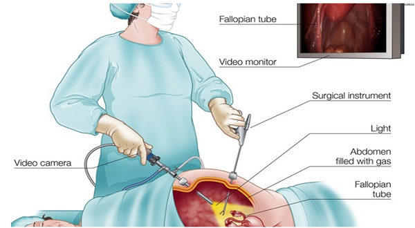All fertility Enhancing Hysterolaproscopy Procedures